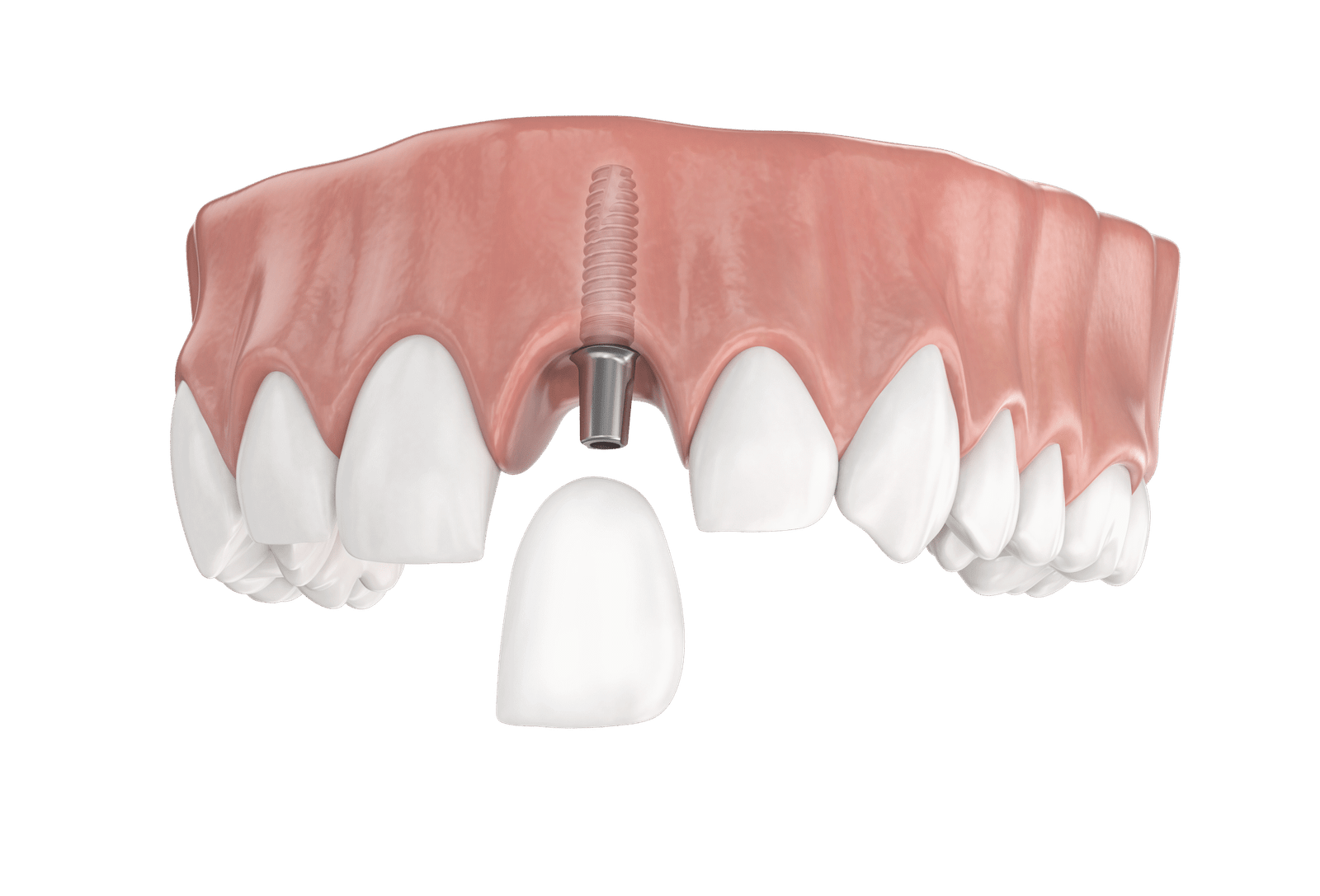 Single-Tooth-Implants