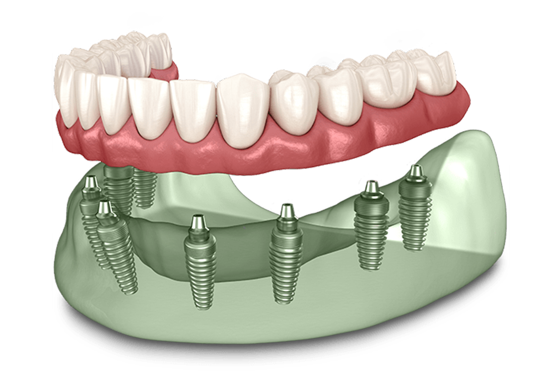 full-arch-implants